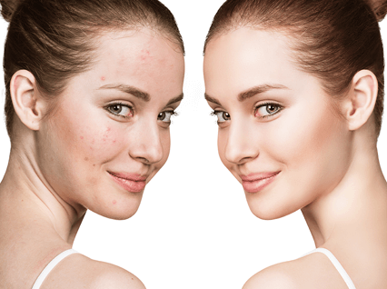 trattamento cicatrici acne