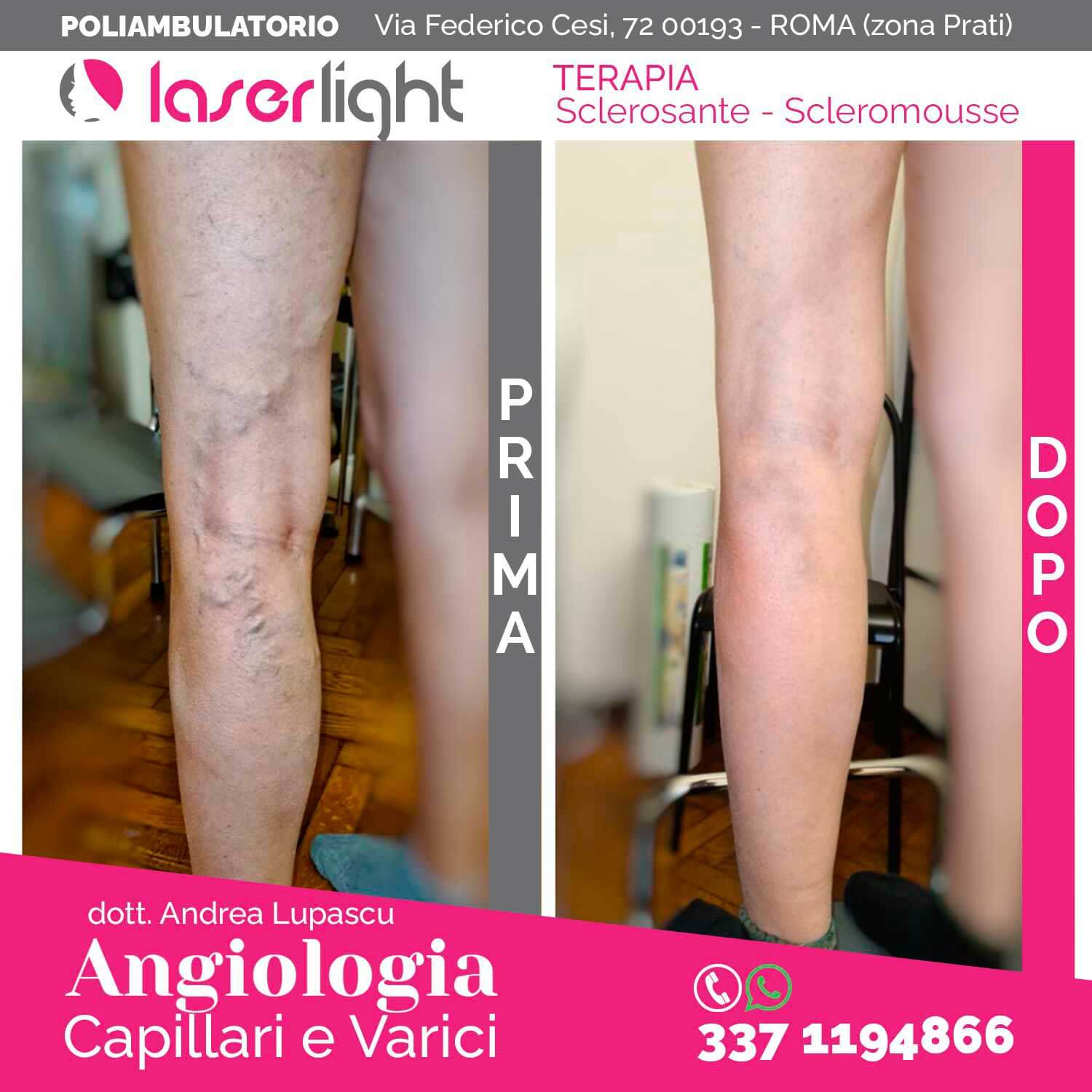 Sclerosante E Scleromousse Trattamenti Angiologia sclerosante-e-scleromousse-trattamenti-angiologia